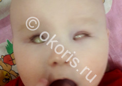 Нужны ли глазные протезы при двусторонней слепоте? Нужны ли глазные протезы при двусторонней слепоте?