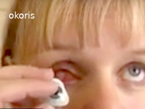 Как вставить и вынуть глазной протез самому Как вставить и вынуть глазной протез самому