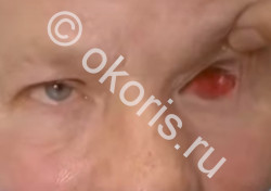 40 лет протезу. Что в результате? 40 лет протезу. Что в результате?