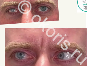 Протез на субатрофичном глазу Протез на субатрофичном глазу