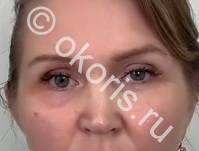 Чтобы глазной протез служил дольше Чтобы глазной протез служил дольше