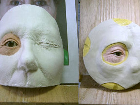 Эктопротезы лица Эктопротезы лица