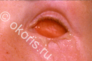 Коньюктивит Коньюктивит