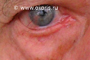 Лагофтальм Лагофтальм