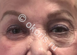 Искусство эктопротезирования при утраченном глазе Искусство эктопротезирования при утраченном глазе