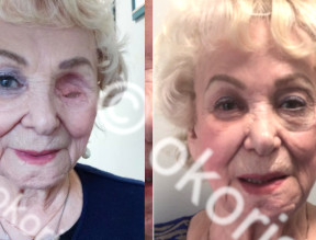 Лицевой протез совмещенный с протезом глазницы Лицевой протез совмещенный с протезом глазницы