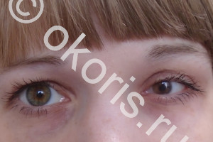 Микрокорнеа Микрокорнеа