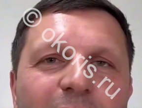 Пример длительного ношения глазного протеза. Не для подражания! Пример длительного ношения глазного протеза. Не для подражания!