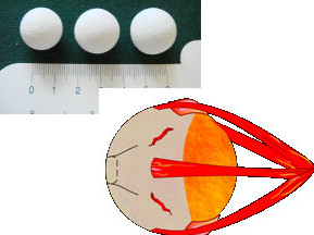 Орбитальные имплантанты Орбитальные имплантанты