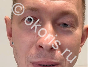 Глазное протезирование после ожоговой травмы Глазное протезирование после ожоговой травмы