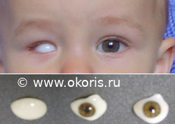 Формирование конъюктивальной полости после удаления глазного яблока Формирование конъюктивальной полости после удаления глазного яблока