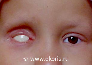 Ретинобластома Ретинобластома