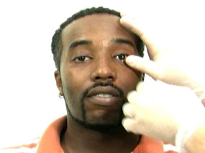 Глазной протез из силикона: окончательная обработка под пациента Глазной протез из силикона: окончательная обработка под пациента