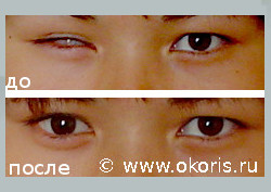 Тонкостенная линза закрыла бельмо Тонкостенная линза закрыла бельмо