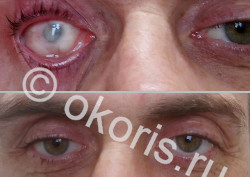 Склеральная и косметическая линзы Склеральная и косметическая линзы