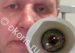 Замена глазного протеза нужна регулярная! Замена глазного протеза нужна регулярная!