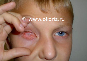 Атрофия глазного яблока Атрофия глазного яблока