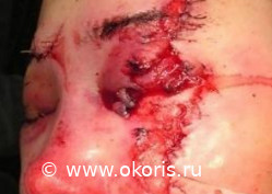 Пациенту, нуждающемуся в операции удаления глаза Пациенту, нуждающемуся в операции удаления глаза