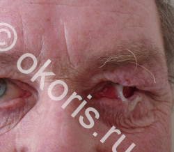 Выделения из глаза с протезом Выделения из глаза с протезом