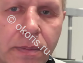 Почему необходимо менять глазной протез? Почему необходимо менять глазной протез?